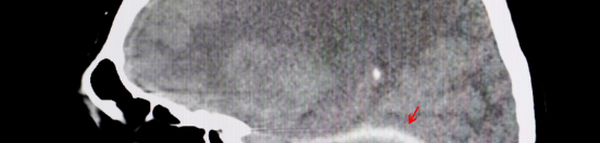 Why You Wake Up With Neck Pain