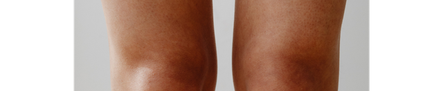 Muscle Weakness & Knee Pain: Key Signs