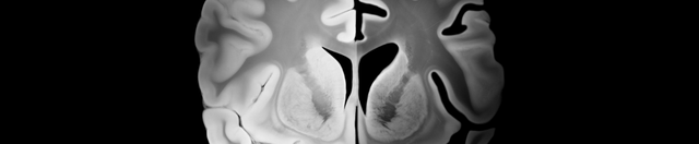 Is Insulin Resistance Linked to Alzheimer's Disease?